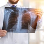 Tuberculosis Radiografía