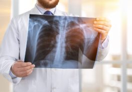 Tuberculosis Radiografía