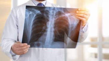 Tuberculosis Radiografía